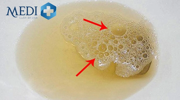Kiểm tra nước tiểu để đánh giá chức năng thận