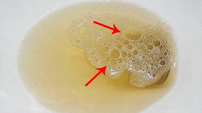 Nước tiểu bình thường: Màu sắc, mùi, tần suất và dấu hiệu bất thường Màu sắc nước tiểu bình thường