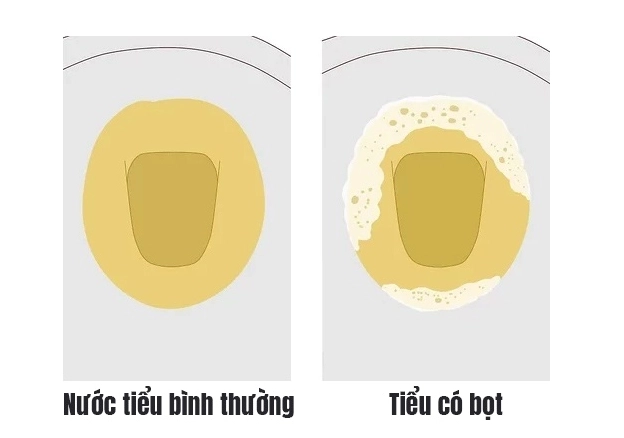 nuoc-tieu-co-bot-khi-nao-binh-thuong-khi-nao-can-lo-lang_327
