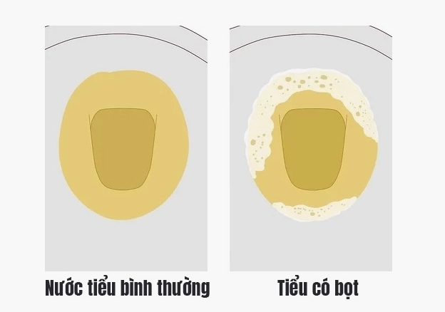 Nước tiểu có bọt liên tục có thể là dấu hiệu bệnh lý