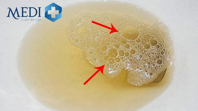 Nước tiểu có bọt: Khi nào bình thường, khi nào cần lo lắng? Tốc độ dòng chảy mạnh khi đi tiểu gây nước tiểu có bọt