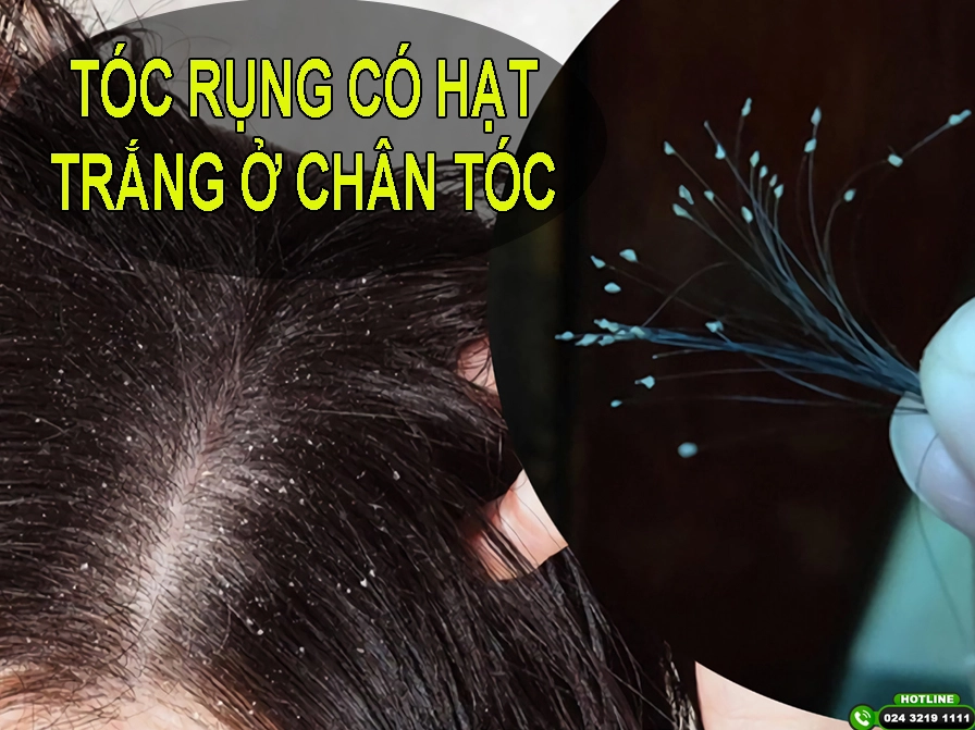 Chân tóc có hạt trắng cần được chăm sóc đúng cách