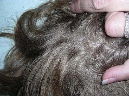 Da đầu bị ngứa và có hạt trắng